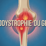 Schéma genou douleur algodystrophie