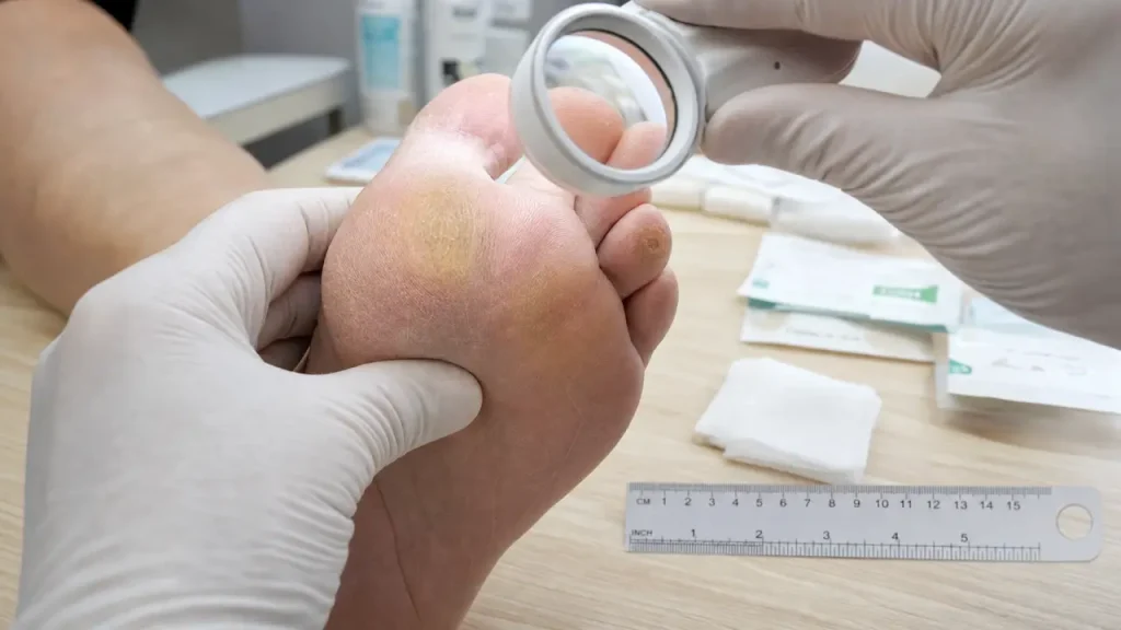 Cor au pied ou durillon : reconnaître la différence, soulager la douleur et éviter les récidives